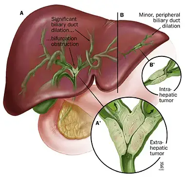 biliary duct cancer market report