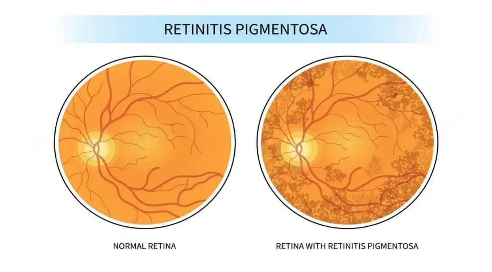 Retinitis Pigmentosa Figure-1-1