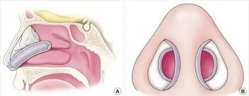 nasal splints Figure-1