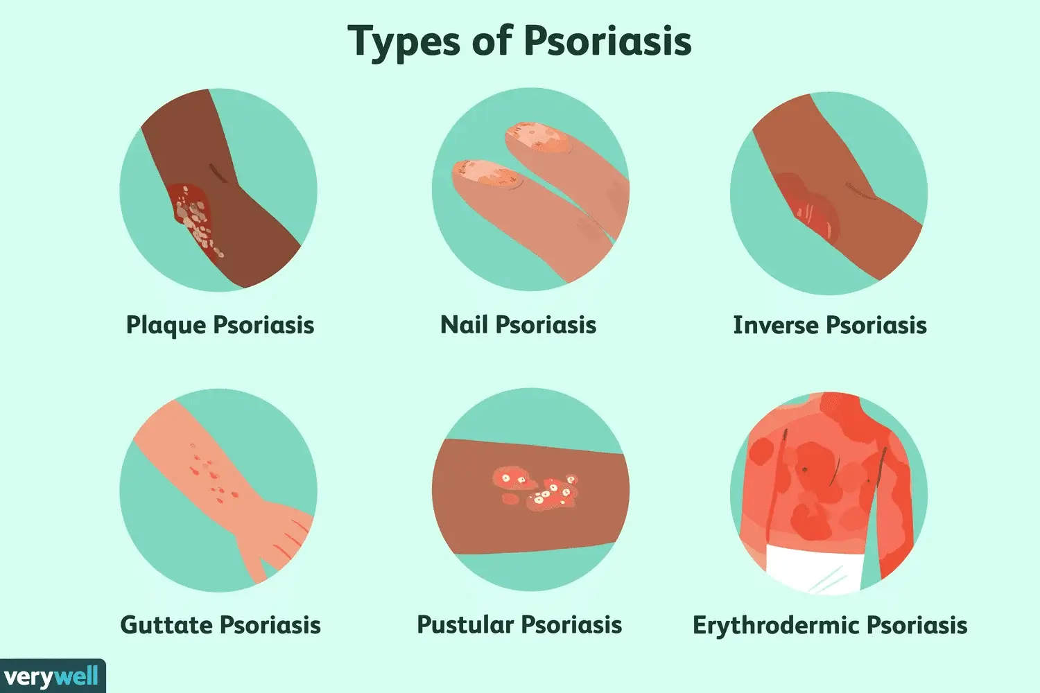 Figure-1-Types-of-Psoriasis