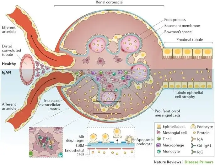 The glomerulus in IgA nephropathy