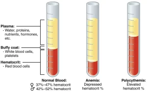 Polycythemia vera fig-1