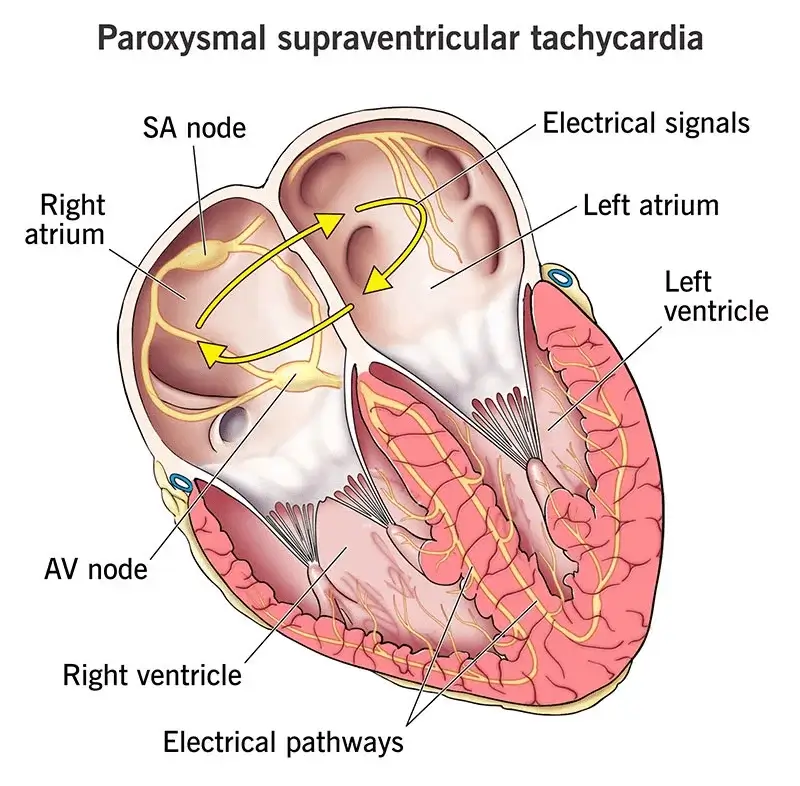 PSVT image