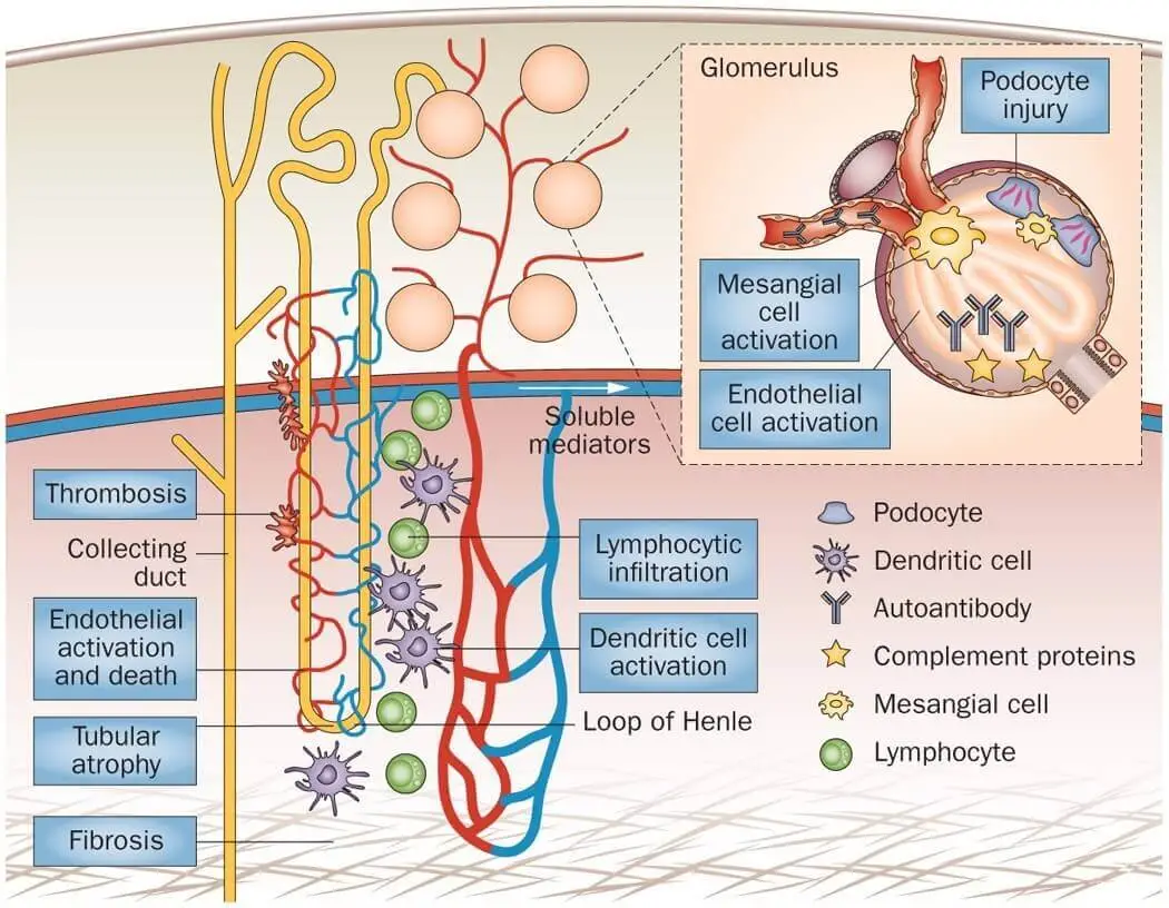 Treatment-of-severe-Lupus-Nephritis