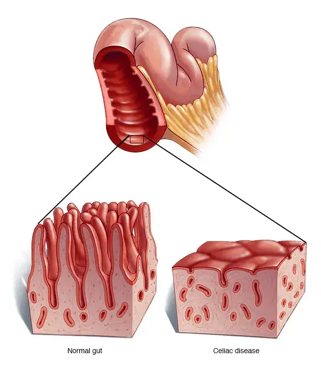 celiac-disease gut