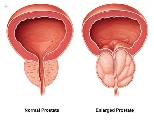 Enlarged prostate due to growing cancer