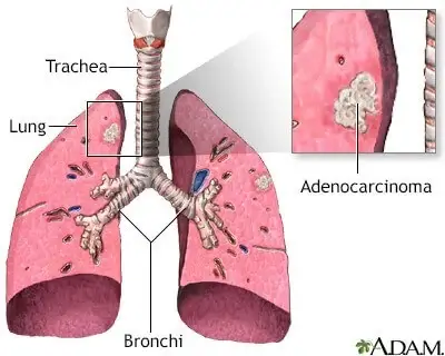 Adenocarcinoma