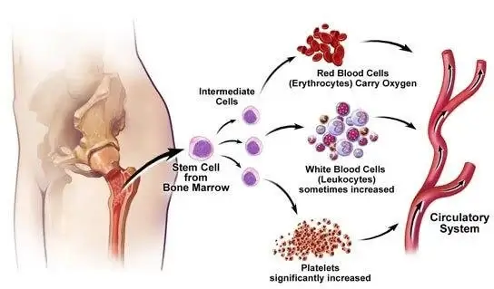 Essentially Thrombocythemia image