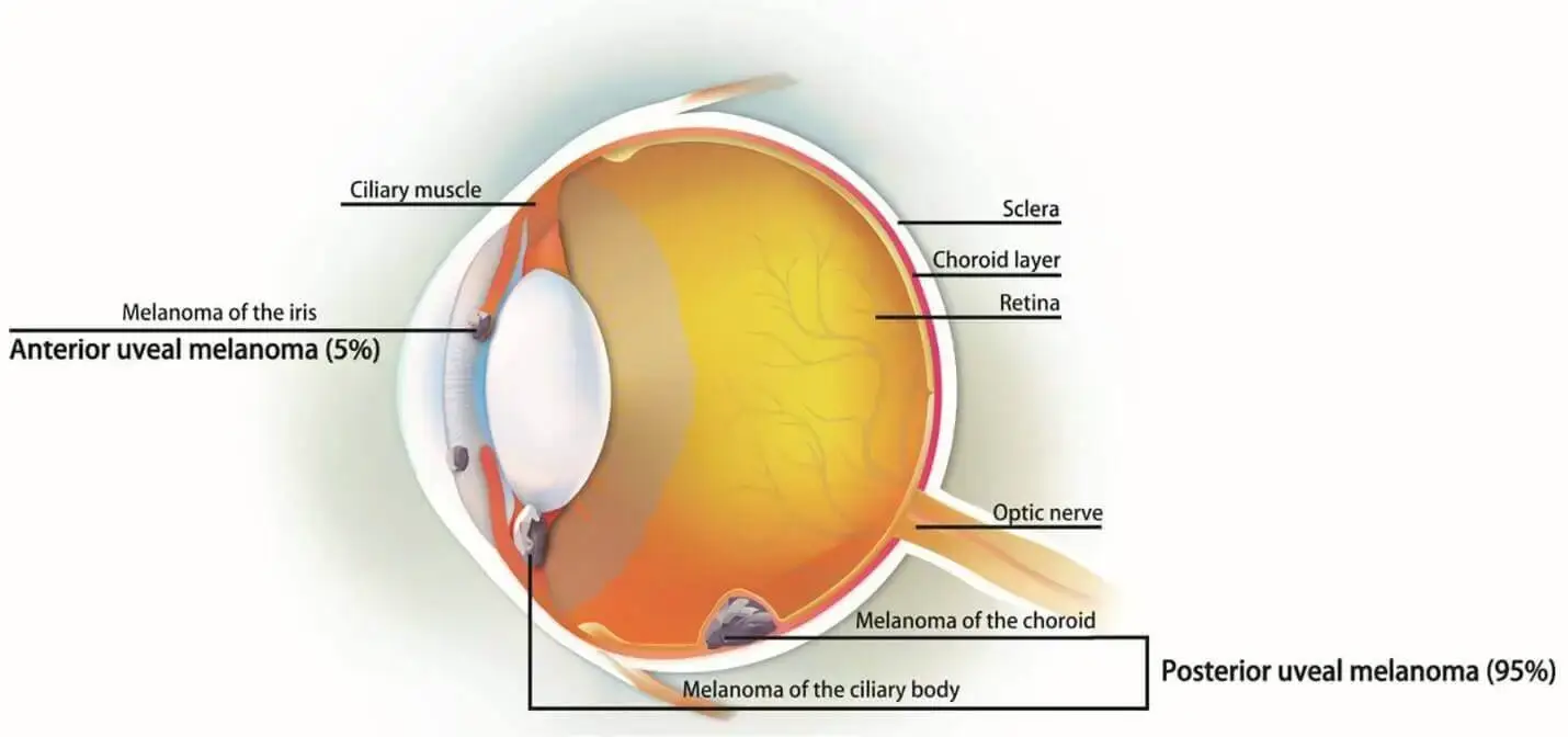 Melanoma origination