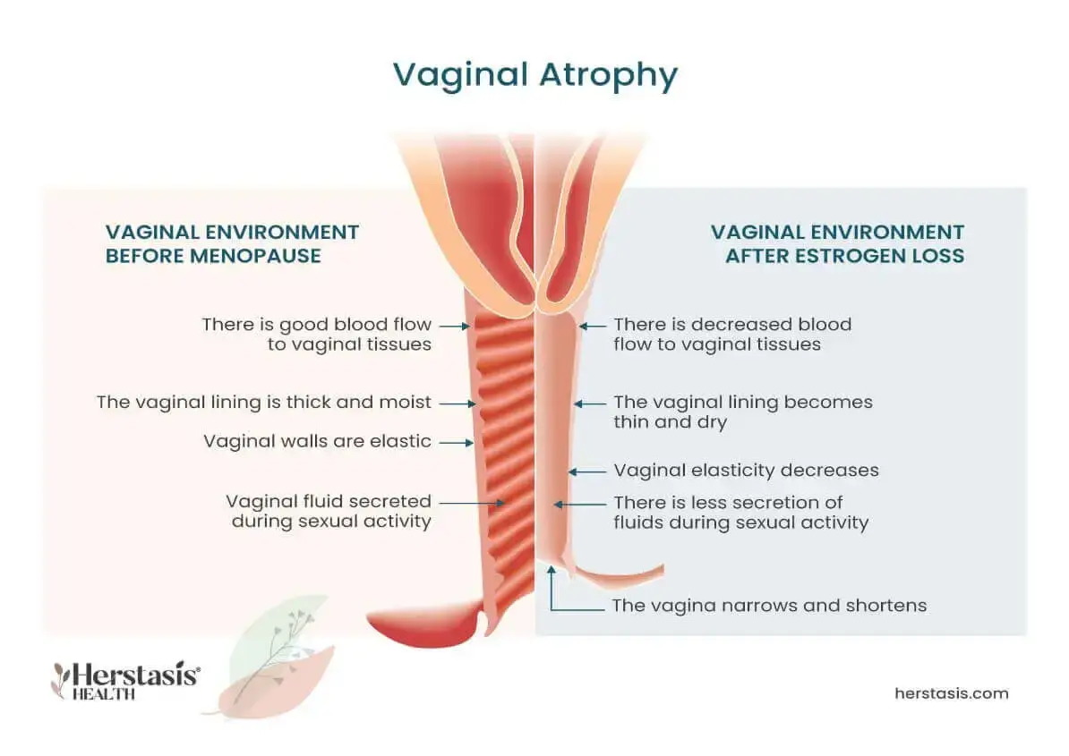 Vaginal-Atrophy